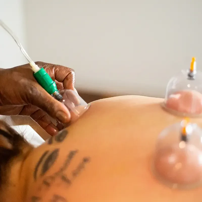 Cupping Massage Cup Placement