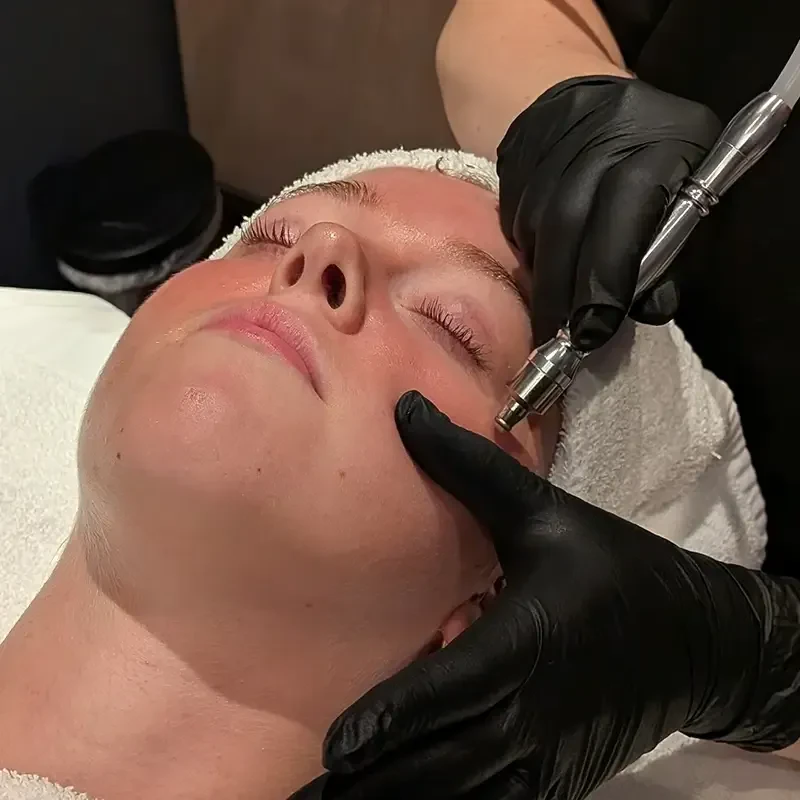 Microdermabrasion