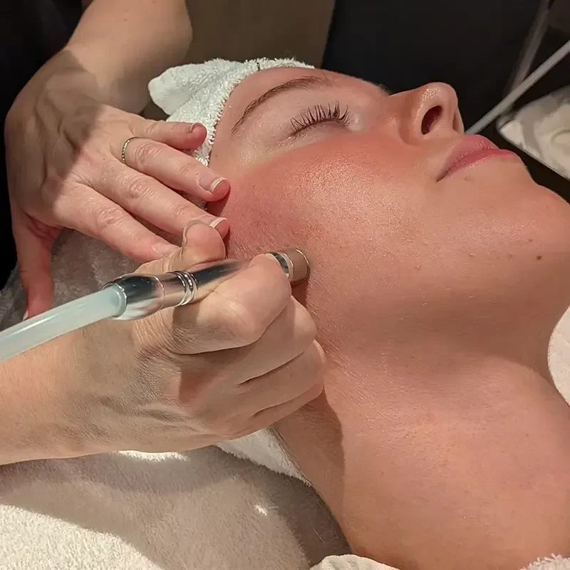 Microdermabrasion Cheek